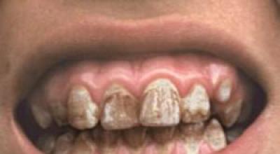 К чему снятся гнилые зубы – основное толкование