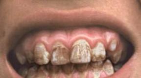 Miks unistate mädanenud hammastest - põhitõlgendus