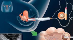 Is IVF done for uterine fibroids?